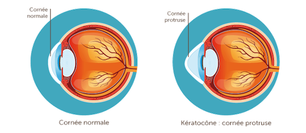traiter_le_kératocône_3